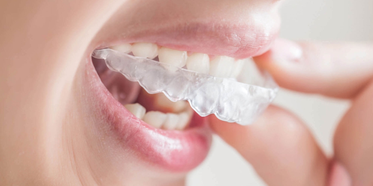 Eledent aligners blog