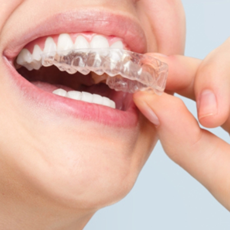 Aligners