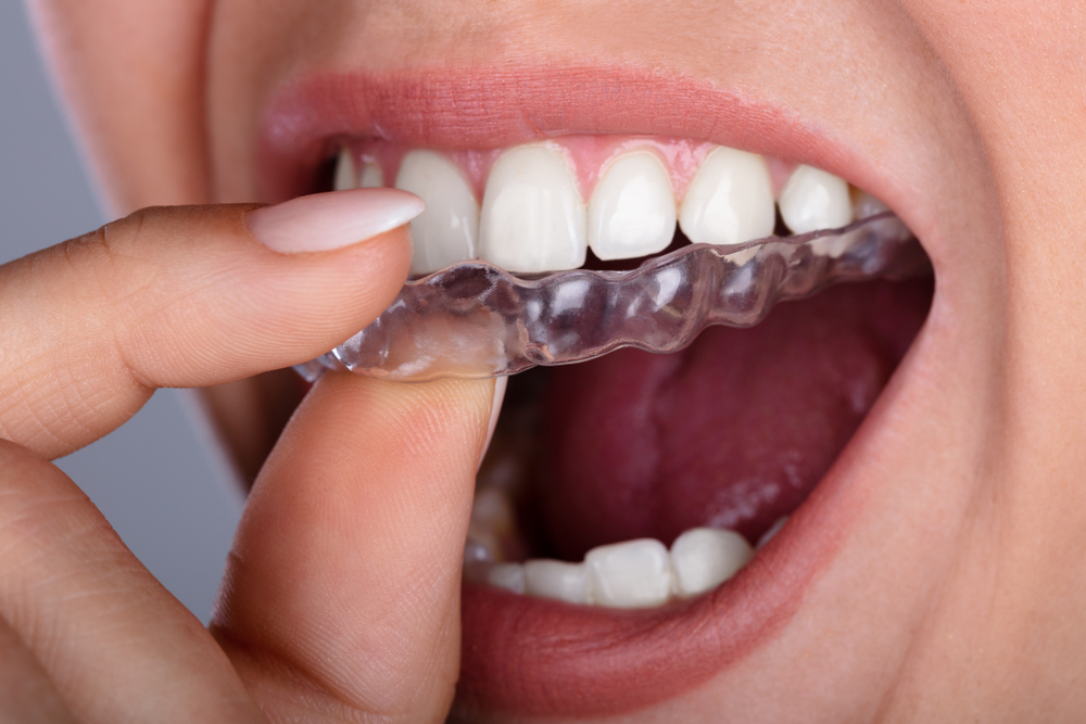 HOW TO WEAR YOUR ALIGNER