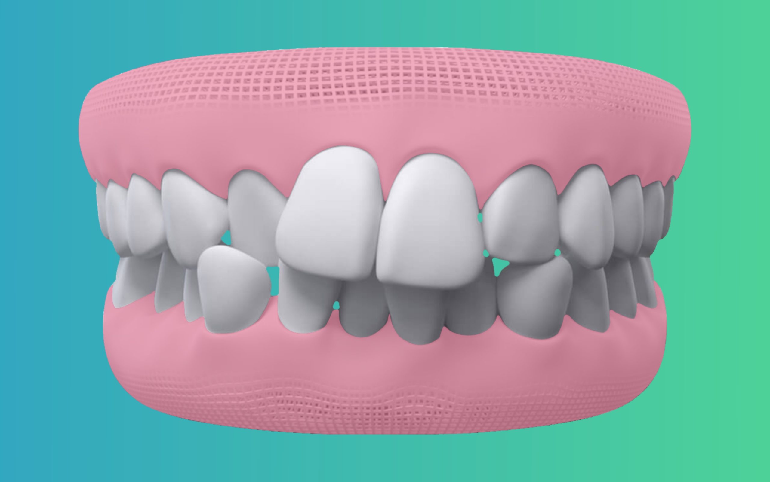 Crowded Teeth