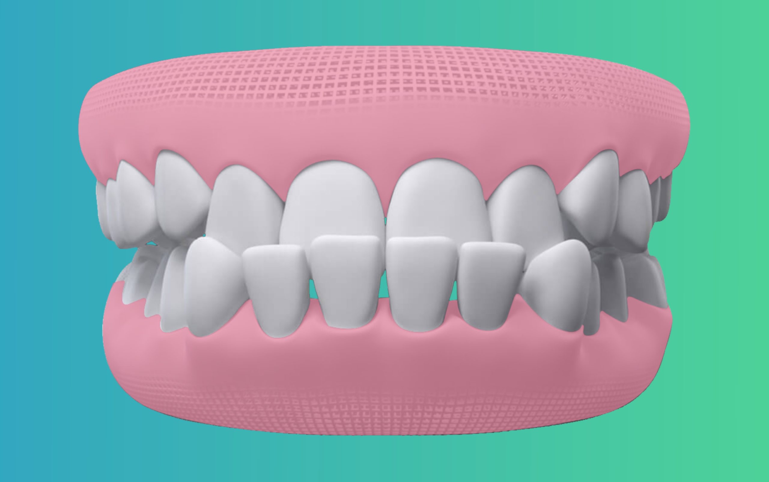 Underbite