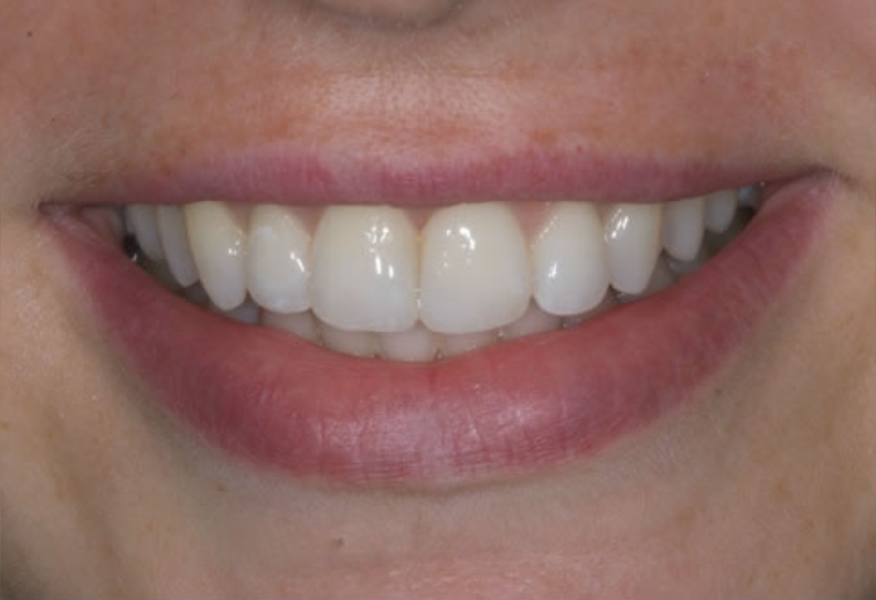 After image