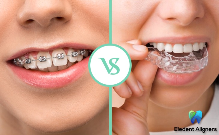 What is Invisible or Clear Aligner? Which is better Eledent Aligners or Braces