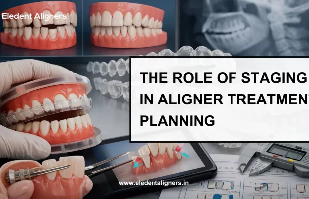 The Role of Staging in Aligner Treatment Planning